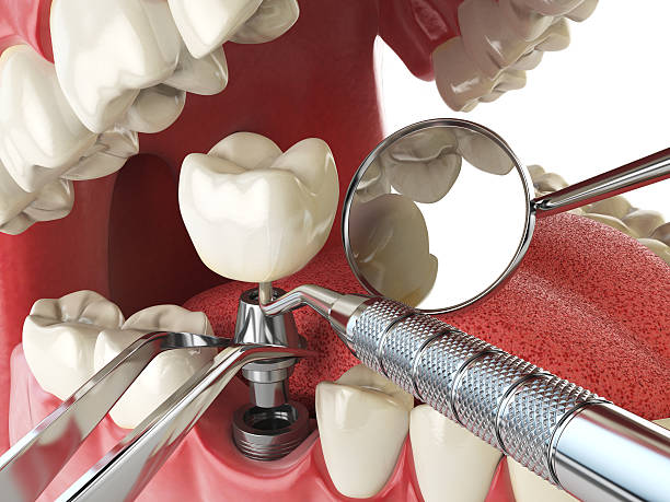 Best Urgent Tooth Repair  in Phoenix Lake, CA